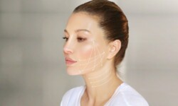 Căng chỉ Collagen là gì? Ưu điểm và chi phí thực hiện - 1