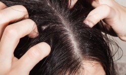 Chọn dầu gội trị nấm dựa trên tình trạng da đầu