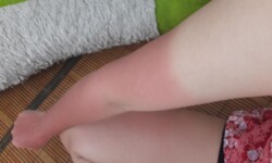 Làm sao có thể phục hồi làn da cháy nắng?