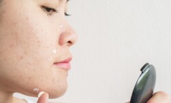 Tại sao phải sử dụng kem chống nắng cho da dầu mụn